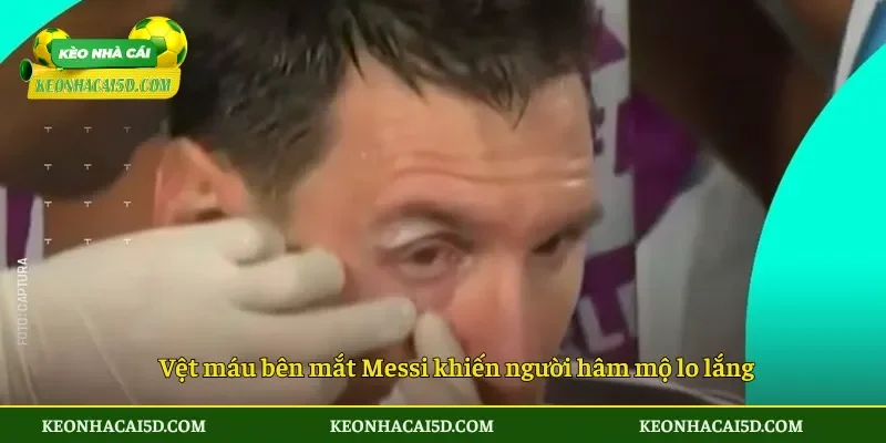 Vệt máu bên mắt Messi khiến người hâm mộ lo lắng